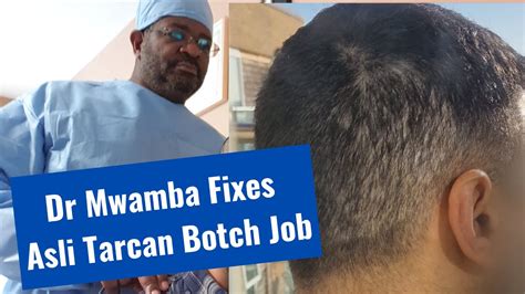 Dr Mwamba Fixes Asli Tarcan Hair Transplant Botch Job YouTube