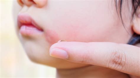 Slapped Cheek Virus Spreads In Us Know Its Symptoms And Who Is At Risk Healthshots