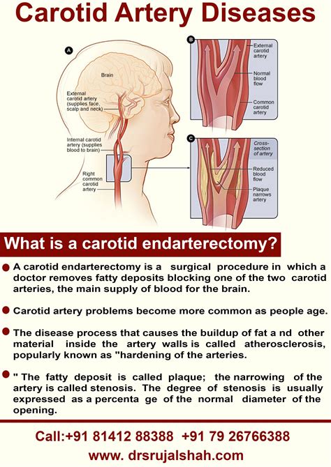 Carotid Endarterectomy Is A Surgical Procedure Used To Reduce The Risk