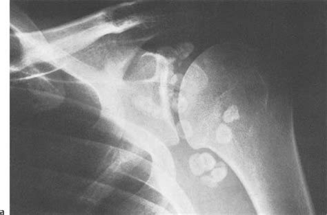 Soft Tissue Calcification