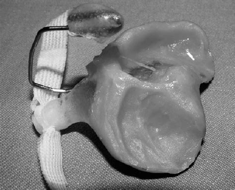 Figure 1 From Effect Of Presurgical Nasoalveolar Molding On Nasal Symmetry In Unilateral