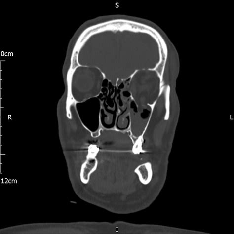 Blow Out Fracture X Ray