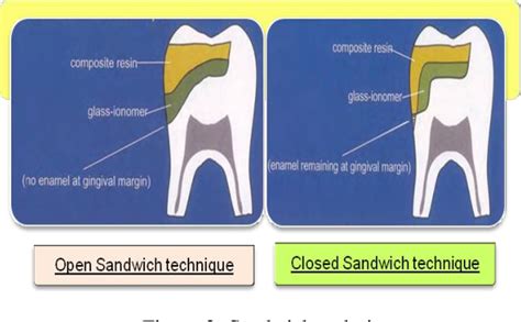 Pdf Glass Ionomer Cement A Magical Genie For All Restorative Needs