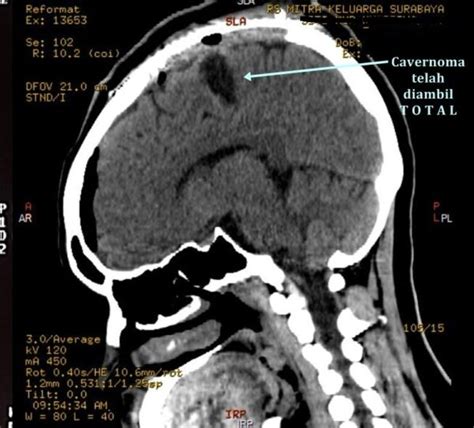 Cavernoma-Image-after-surgery - Brain and Spine Center