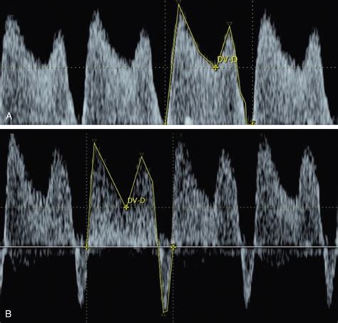 Doppler Ultrasound Evaluation Of The Fetus And Placenta Radiology Key