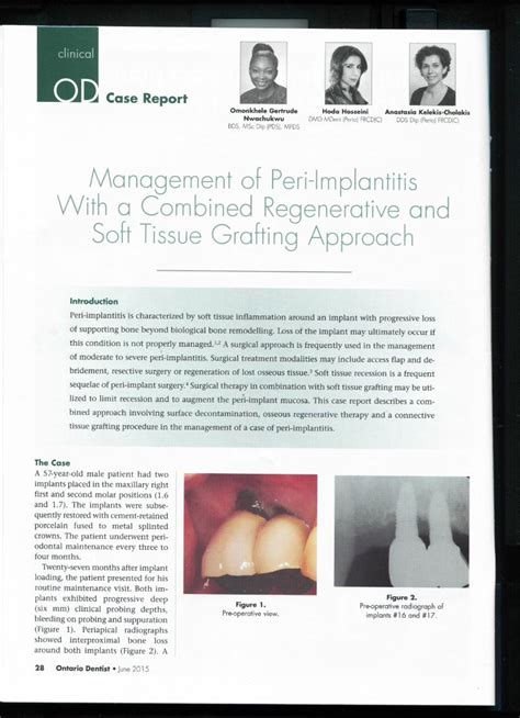 Pdf Management Of Peri Implantitis Using A Combined Regenerative And Soft Tissue Grafting