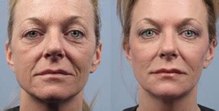 Facial Aerobics Exercises For Men And Women Organic Japanese Facelift