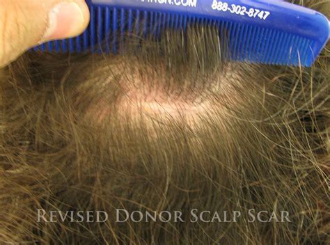 Hair Transplant Scar Revision Medscar