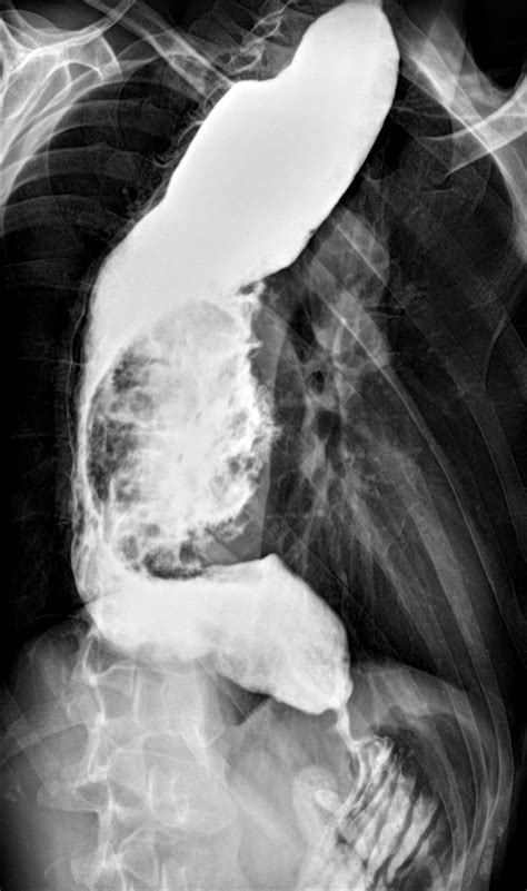 Large Esophageal Cancer In A Patient With Achalasia Image