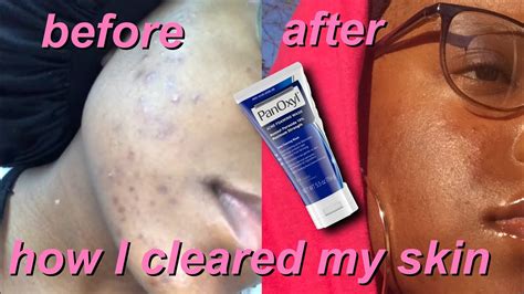 How To Clear Acne In A Week Using Panoxyl How I Got Rid Of My Severe