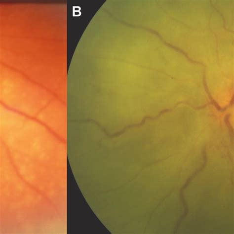 Uveitis In Vogt Koyanagi Harada Vkh Disease A Swollen Pink Optic