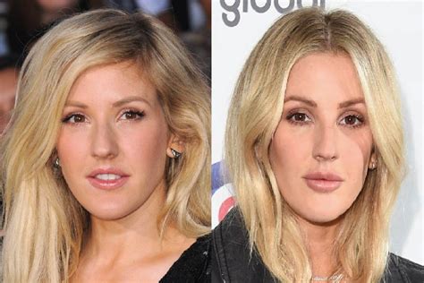 Has Ellie Goulding Had Cosmetic Surgery Mya Cosmetic Surgery