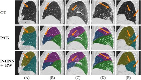 Lung Lobe Segmentation Using George Et Al S Technique P Hnn