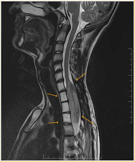 Spinal Ganglioglioma-MRI - Sumer's Radiology Blog