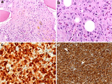 A Case 3 Histiocytic Sarcoma Involving The Bone Marrow 100 B