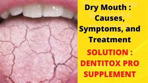 Dry Mouth Causes Symptoms And Treatment