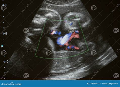 Ultrasound Photo Of Unborn Baby In Mother S Womb Closeup View Stock