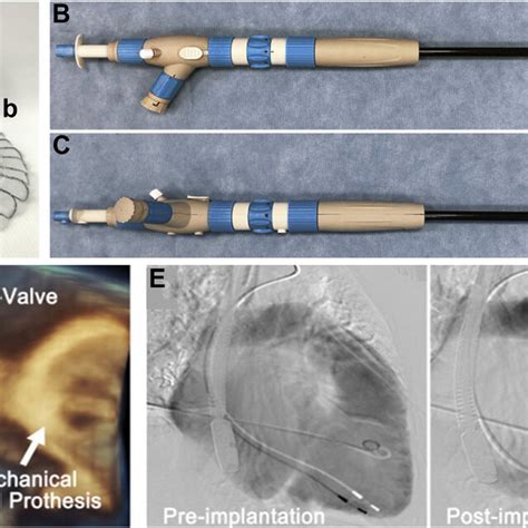 Lux Valve Implantation A Midesophageal Biplane Views Showing Severe Download Scientific