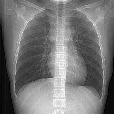 Mediastinal Teratoma Image