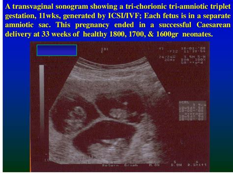 A Transvaginal Sonogram Showing A Tri Chorionic Tri Amniotic Triplet