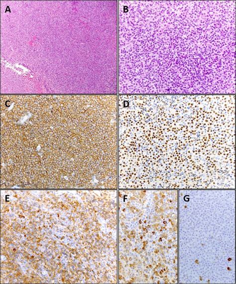 Genomic Landscape Of Epsteinbarr Virus Positive Extranodal Marginal