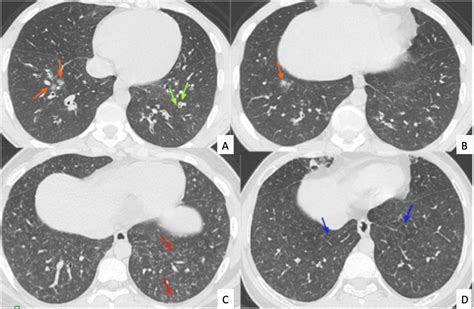 The Role Of Hrct In Tropical Pulmonary Eosinophilia European Journal