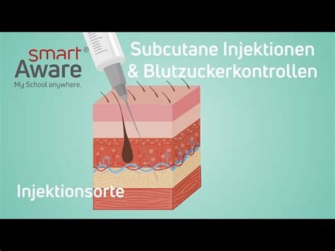 Subcutane Injektionen Und Blutzuckermessung Injektionsorte