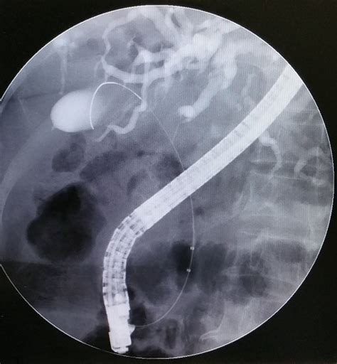 应用胆胰内镜（ercp）治疗伴有胆囊管结石的胆总管结石患者胆胰内镜网