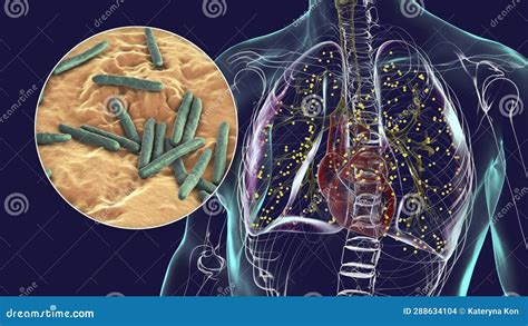 Human Lungs Affected By Miliary Tuberculosis With A Close Up View Of