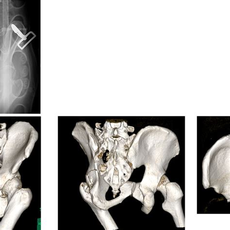 A Anteroposterior X Ray At The Emergency Room With A Pelvic Binder