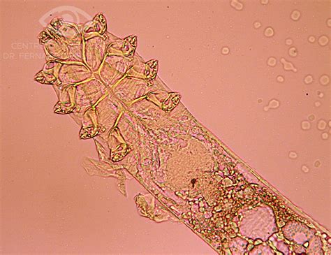 Demodex Folliculorum Adulto Compendio De Imágenes De Oftalmología