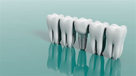 Carga inmediata implantes Clínica Dental CEMEQ