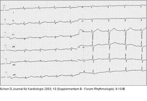 Abbildung 1 Brugada Syndrom EKG