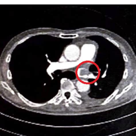 Contrast Enhanced Chest Computed Tomography Image The Circle Indicates