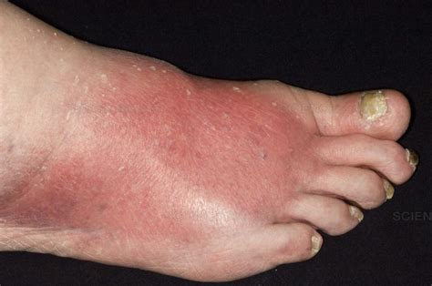 Cellulitis Cks