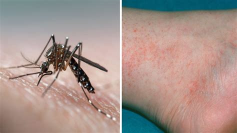 Diseases Spread By Mosquitos And Ticks On Rise For Summer 2018 How To