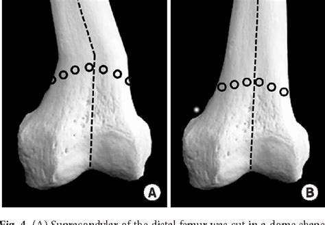 Figure 1 From Deformity Correction By Femoral Supracondylar Dome