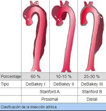 El Rinc N De La Medicina Interna Var N De A Os Con Disecci N