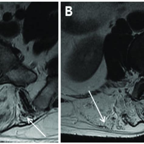 Magnetic resonance image (MRI) of the lumbar spine. (A) L5-S1 disc ...