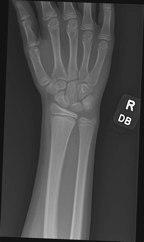 Orthodx Distal Radius Epiphyseal Fracture Clinical Advisor