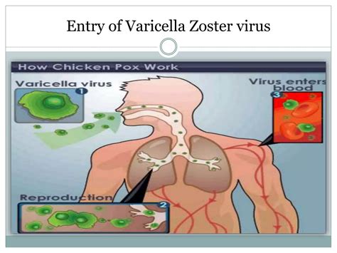 varicella zoster virus infections pptx
