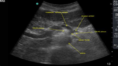 Celiac Trunk Artery Anatomy