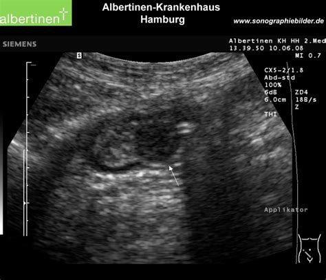 Terminal Ileum Ultrasound