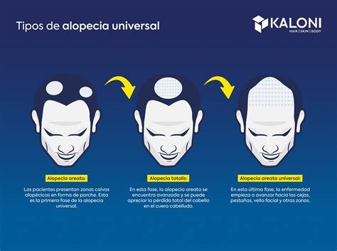 Alopecia Universal Síntomas y tratamientos Costo y precio