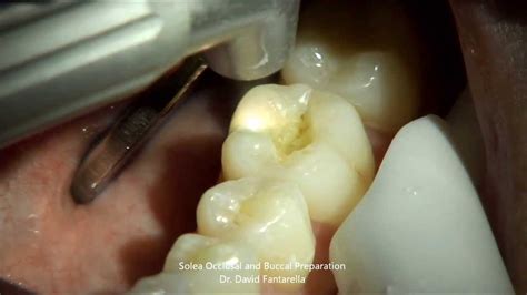 Solea Laser Occlusal Preparation Dr David Fantarella Youtube