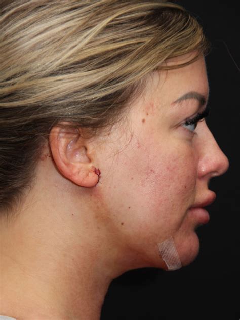 Patient Chin Implants C Solomon Facial Plastic