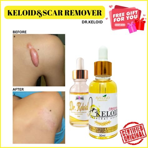 Healing Dr Keloid Keloid Remover Scar Removes Any Types Of Scar Keloids Caesarean Scar