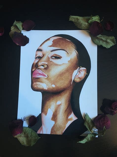 Vitiligo Beauty Art Print Female portrait Art Print | Etsy