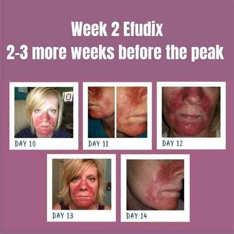 Best Efudix For Sun Spots Treatment In Brisbane Dr Davin Lim