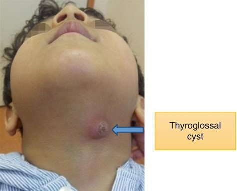 Thyroglossal Cyst Dentowesome